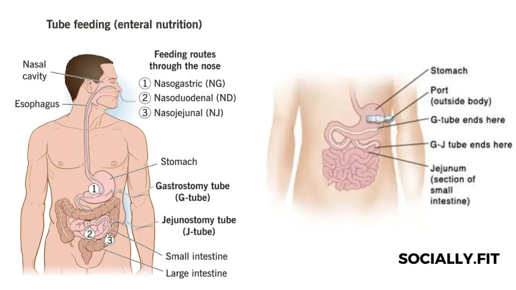 What is Home Enteral Nutrition